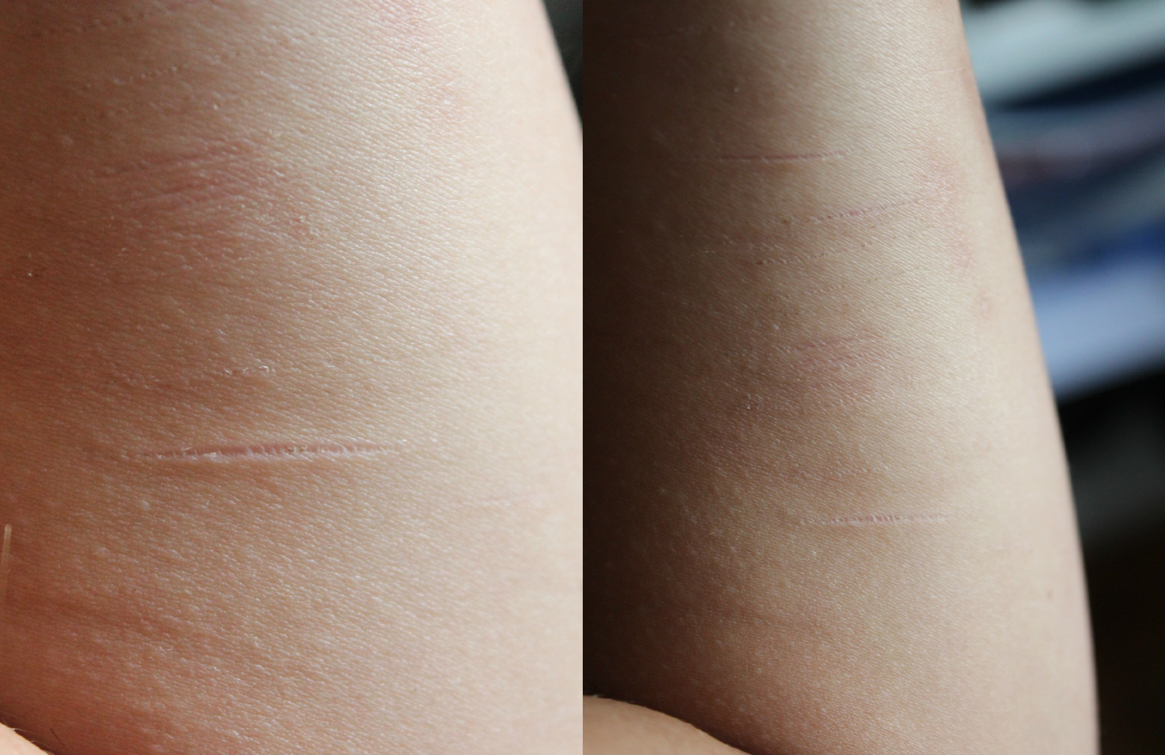 Narben Vom Ritzen Entfernen – Narben-Behandlung am Dermatologikum ...