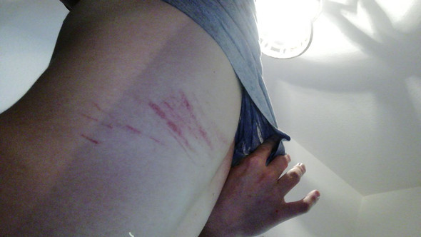 Bleiben Von Einer Verletzung Am Stacheldraht Narben Fahrrad Blut Unfall