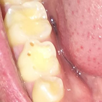 Zahn Karies - (Gesundheit und Medizin, Arzt, Schmerzen)