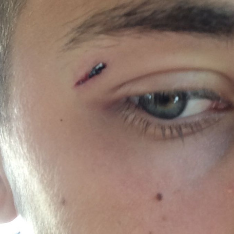 Bleibt Eine Platzwunde Die Oberhalb Des Auges Ist Und Nicht Genaht Wurde Als Narbe Gesundheit Arzt Fussball