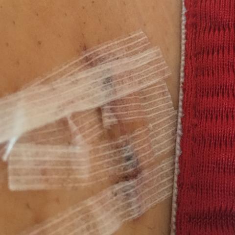 Blinddarm Op Vor 4 Tagen Wann Kann Ich Duschen Gehn Faden Sind Drin Und So Kleine Pflaster Druber Krankenhaus Operieren Blinddarm Op Vor 4 Tagen Wann Kann Ich Duschen Gehn Faden Sind Drin Und So Kleine Pflaster Druber Krankenhaus Operieren