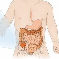 Blinddarmentzundung Oder Sonst Etwas Schmerzen Blinddarm Blinddarmentzundung Oder Sonst Etwas Schmerzen Blinddarm