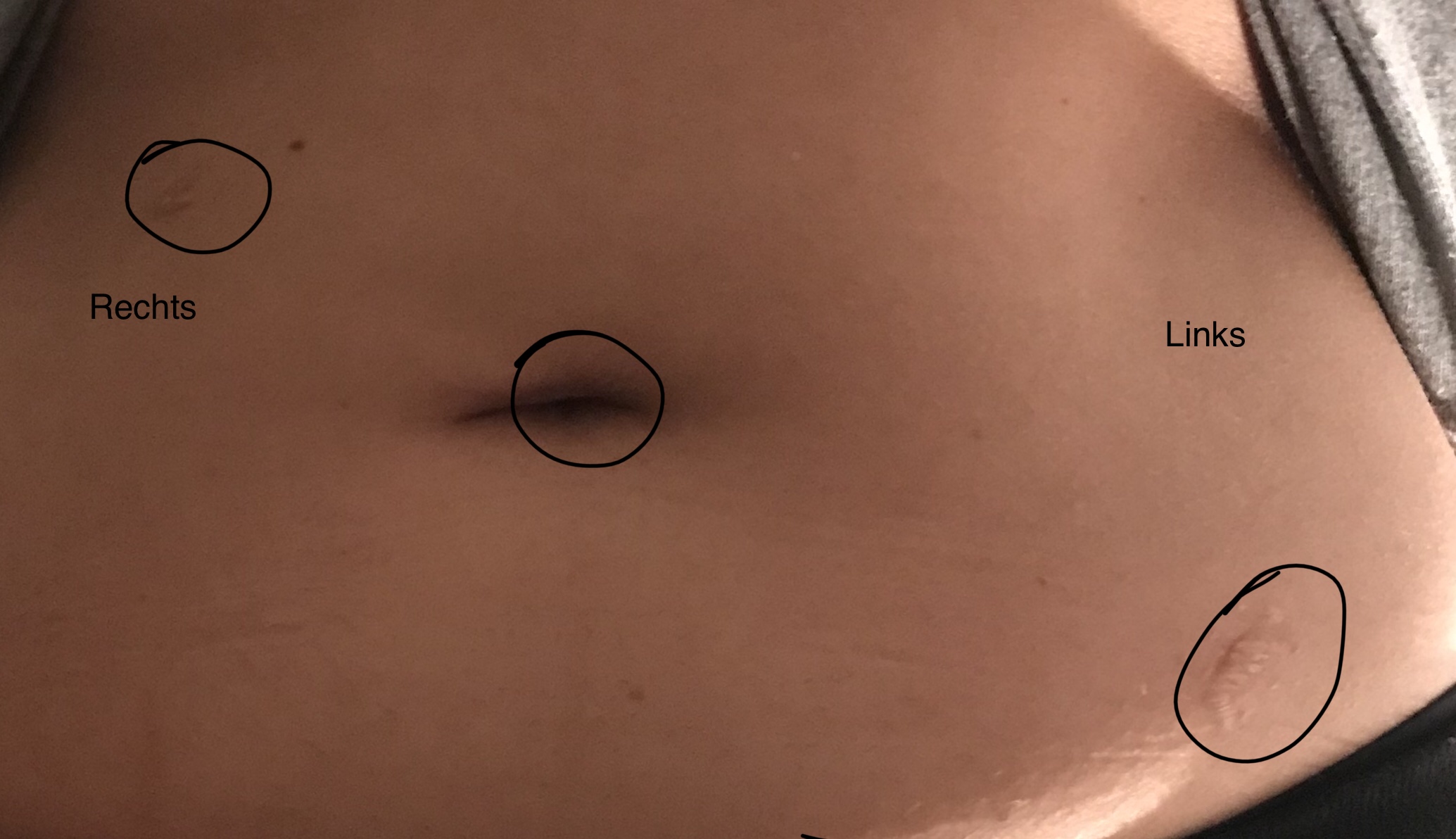 Blinddarmnarbe Am Oberbauch Gesundheit Und Medizin Operation Narben Blinddarmnarbe Am Oberbauch Gesundheit Und Medizin Operation Narben