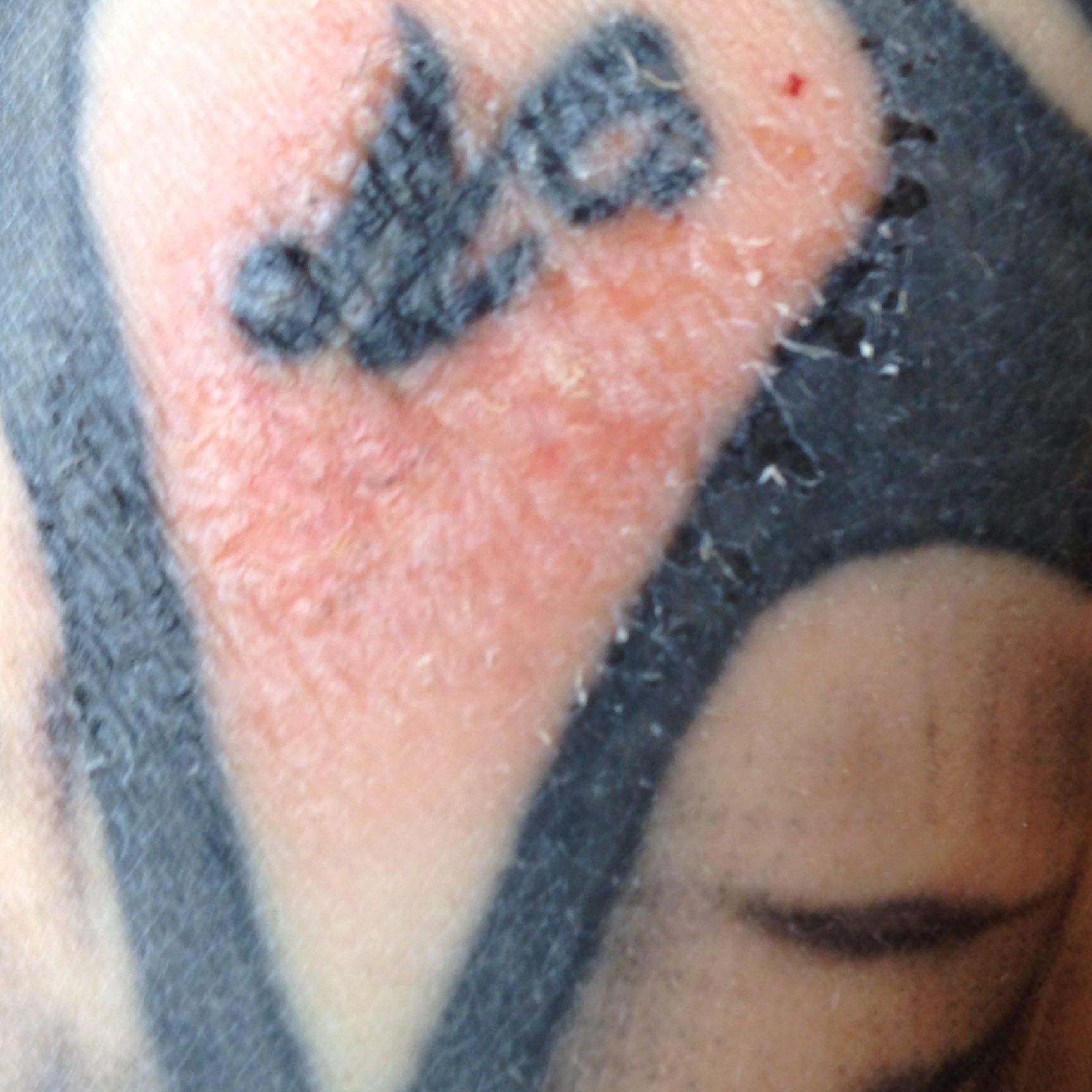 Blöde Wunde auf dem Tattoo (Verletzung)