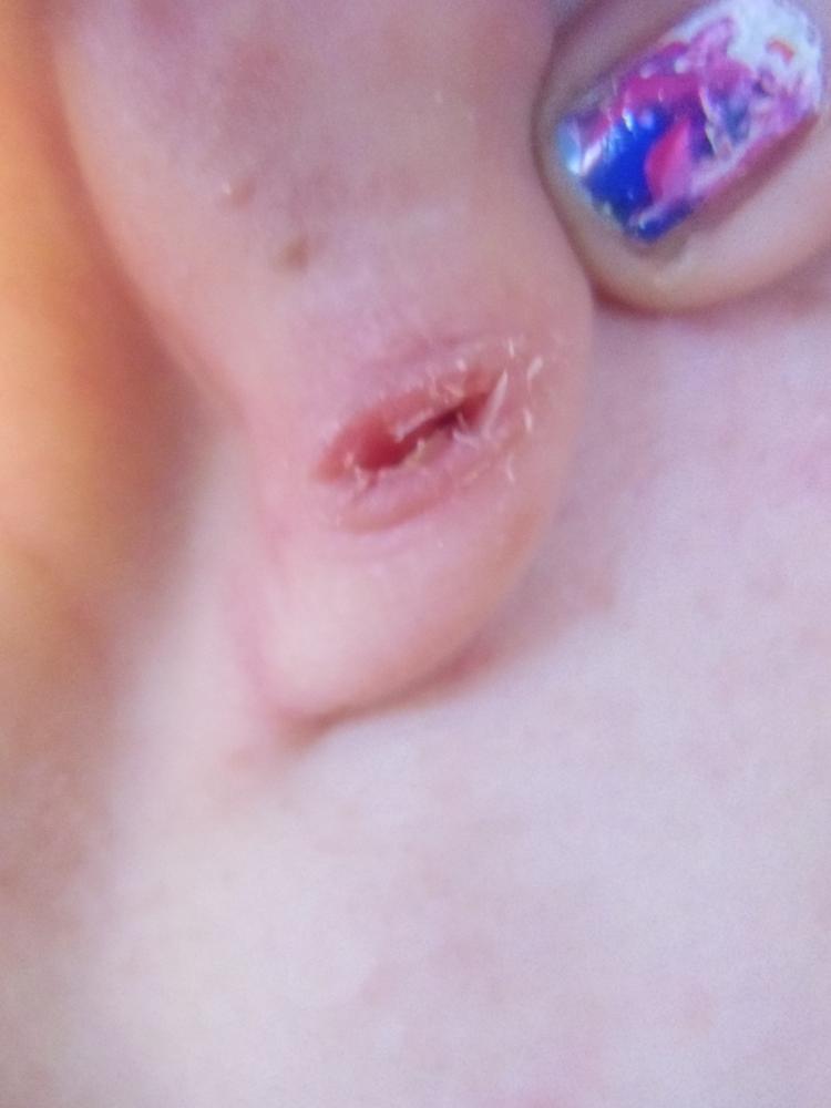 Blowout Ja oder Nein? (Piercing, Ohr, Tunnel)