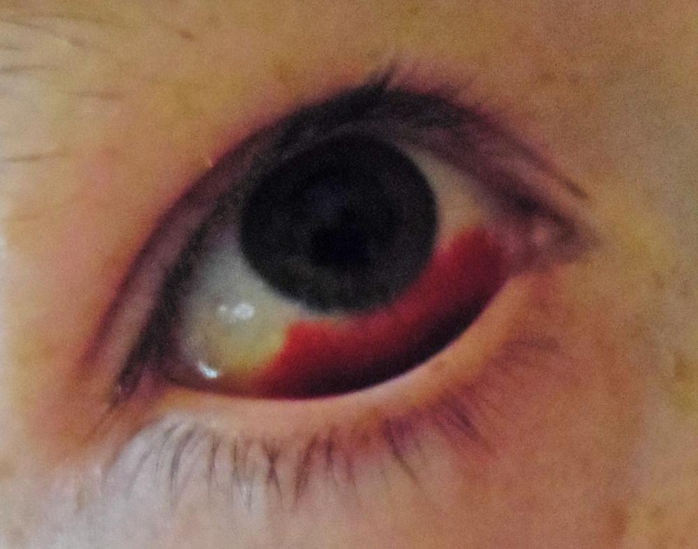 Blut im Auge. Augenarzt? (Arzt, Augen)