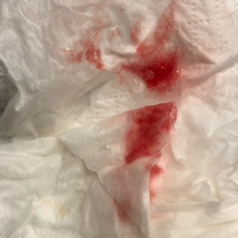 Blut Im Auswurf Was Ist Das Gesundheit Und Medizin Arzt Krank Blut Im Auswurf Was Ist Das Gesundheit Und Medizin Arzt Krank