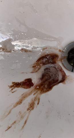 Blut Im Erbrochenen Sry Fur Das Bild Gesundheit Und Medizin Erbrechen Magenkrampfe Blut Im Erbrochenen Sry Fur Das Bild Gesundheit Und Medizin Erbrechen Magenkrampfe