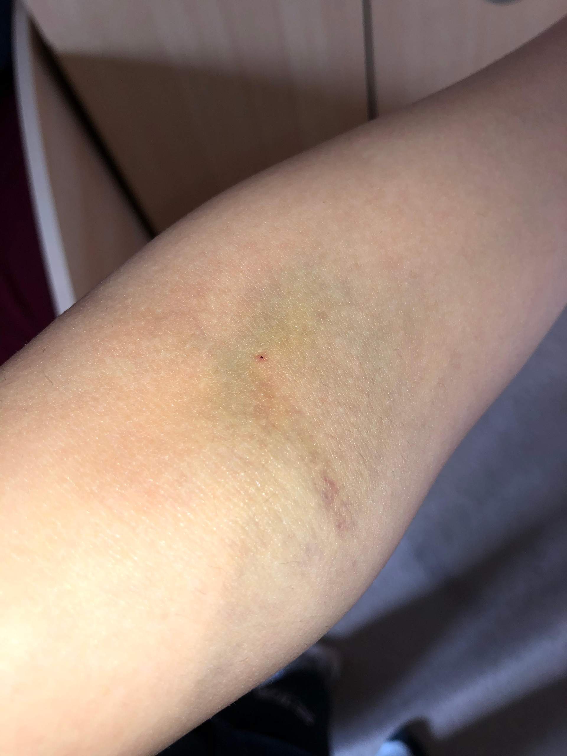 Blutabnahme sieht das normal aus? (Gesundheit und Medizin, Gesundheit, Medizin) Blutabnahme sieht das normal aus? (Gesundheit und Medizin, Gesundheit, Medizin)