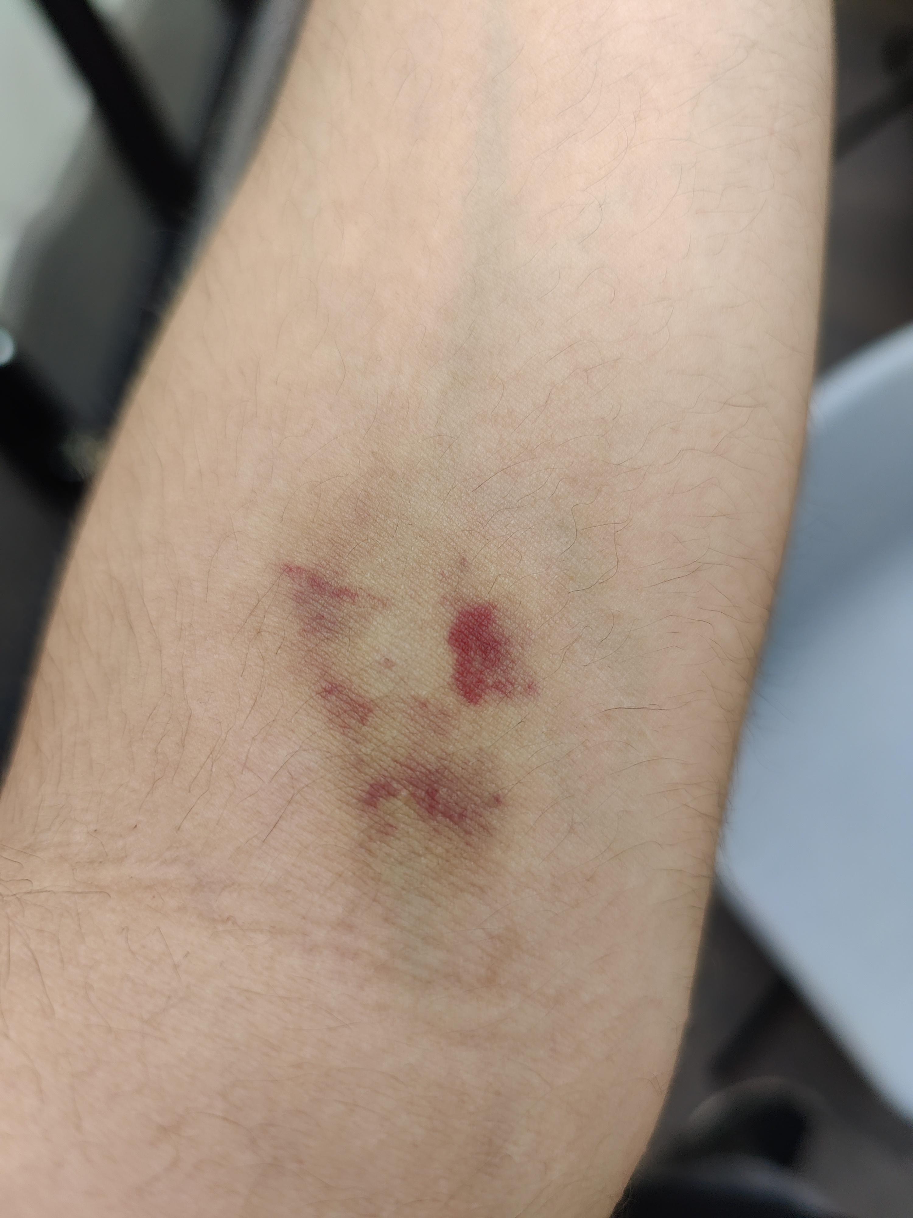 Blauer Fleck Nach Blutabnahme - Pregnancy Informations