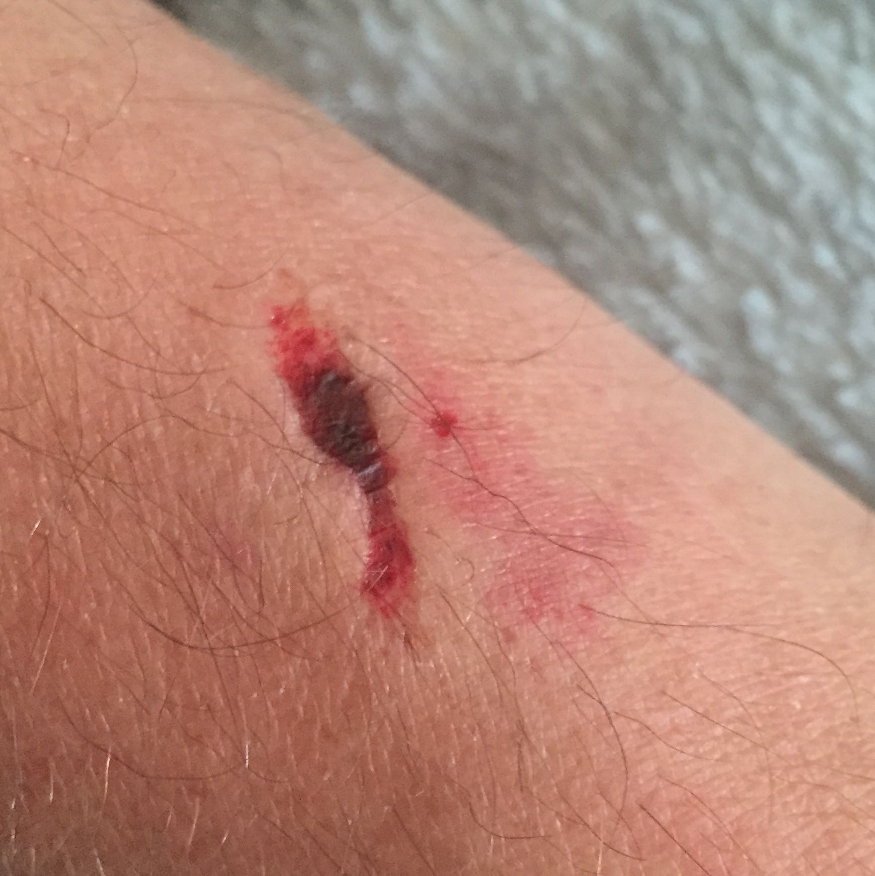 Kann es eine Blutvergiftung sein? Hundebiss (Hund, Blut, Biss)