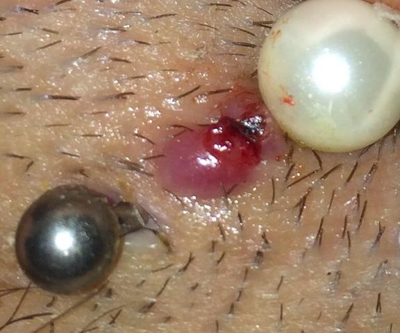 blutblase am chrissy piercing gesundheit korper beauty