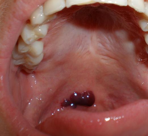 44++ Blutblase im mund bilder , Blutblase um Mund aufgegangen (Bakterien)
