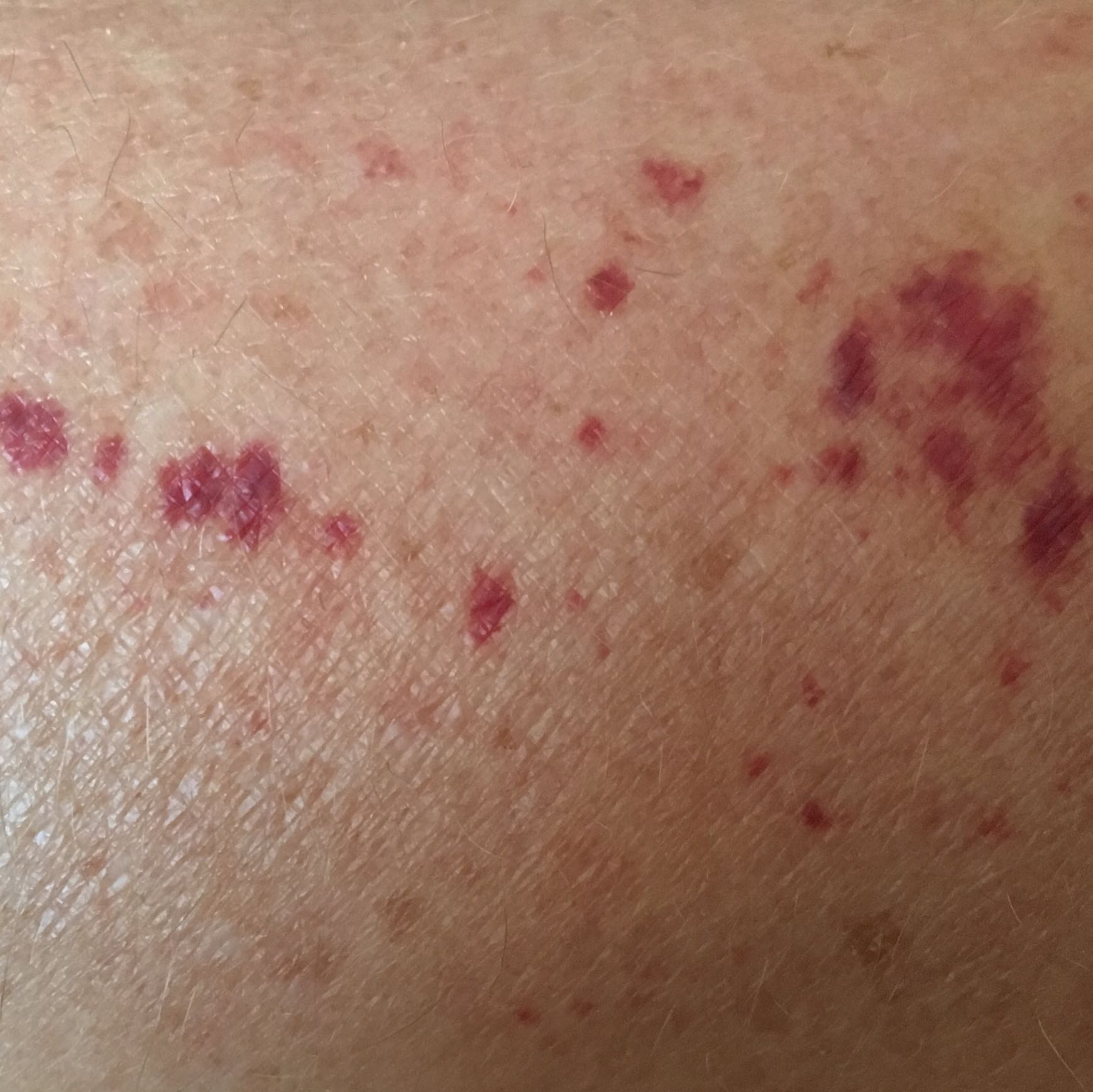 blauer fleck nach blutabnahme - DrBeckmann