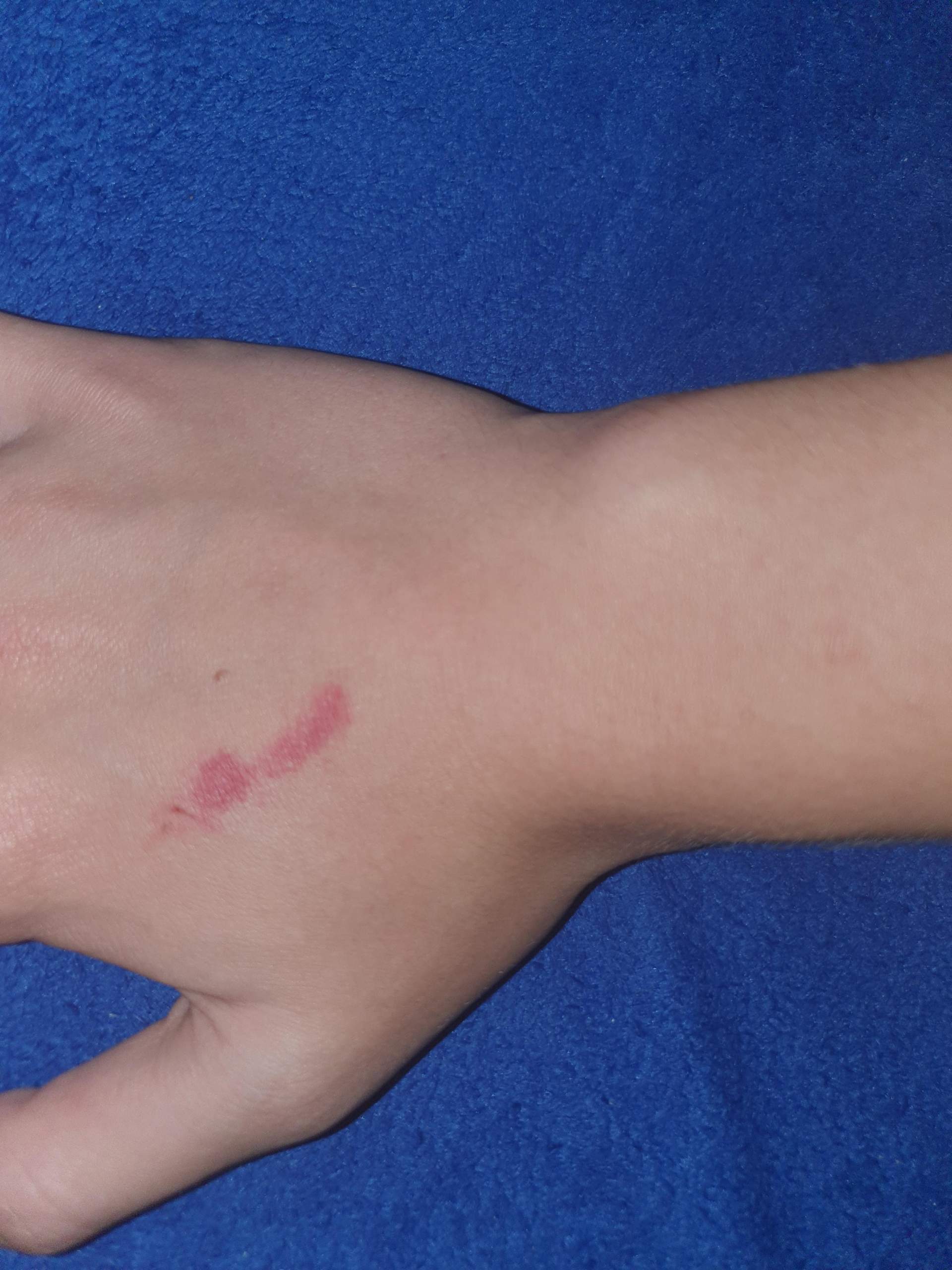 Bluterguss an der Hand? (Gesundheit und Medizin, Gesundheit)