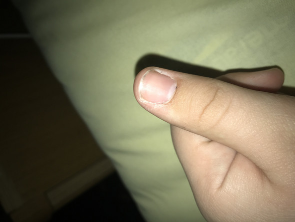 Finger in autotür gequetscht