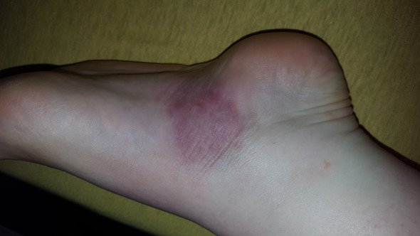 Bluterguss oder etwas anderes? (Füße, Stich)