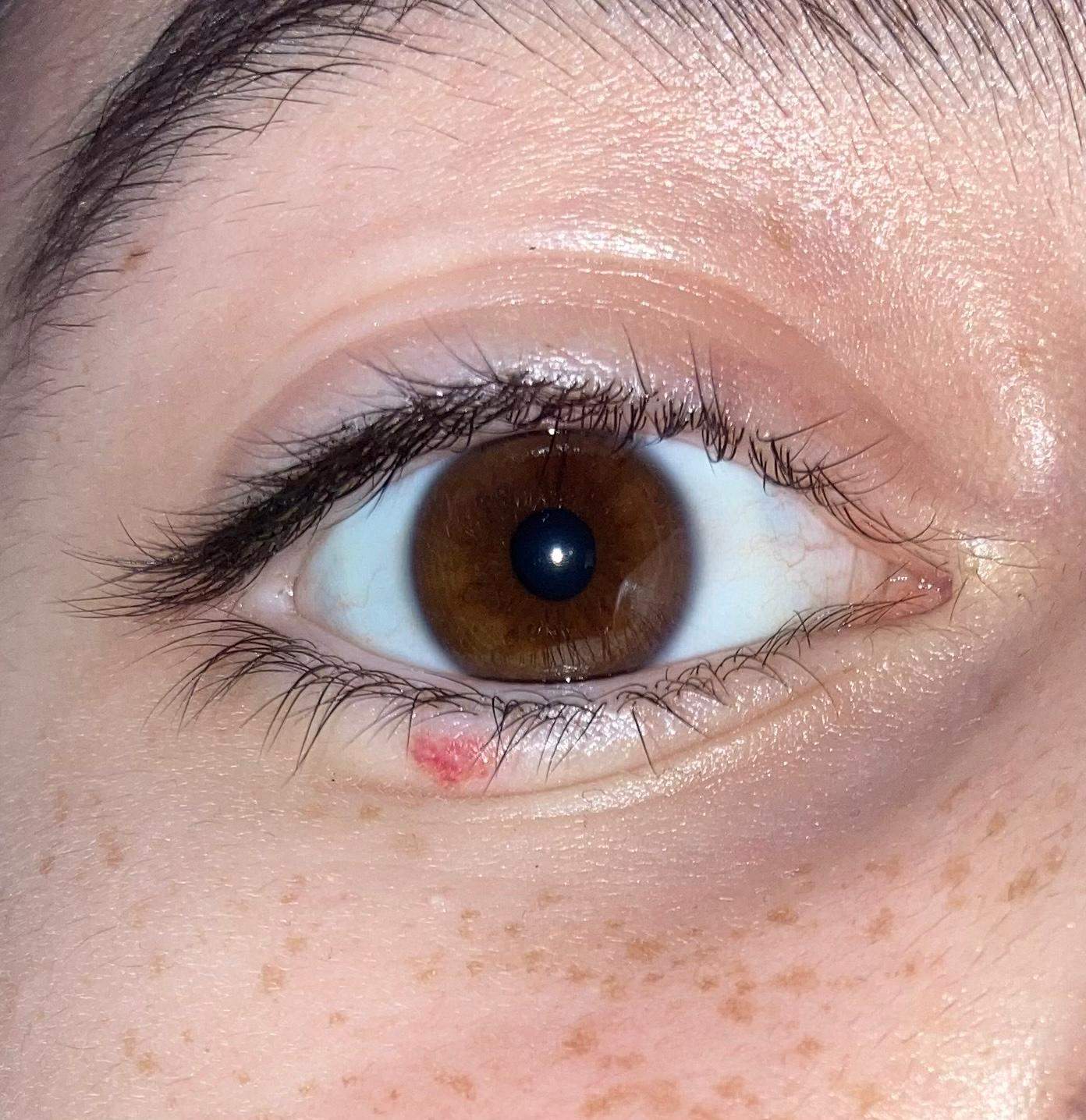 Spontaner Bluterguss Unter Dem Auge Ohne Grund