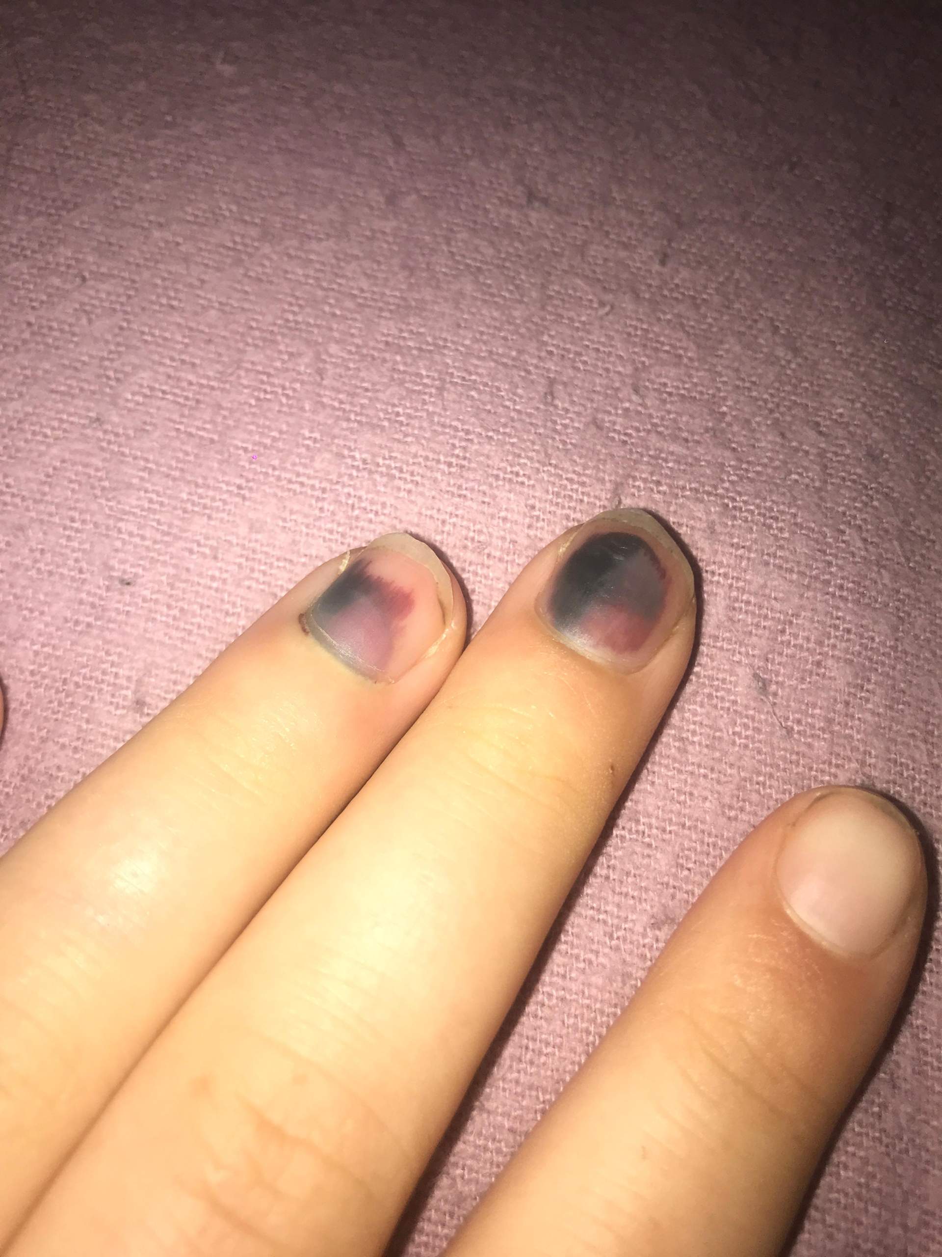 Bluterguss unter Fingernagel zum Arzt gehen? (Gesundheit und Medizin