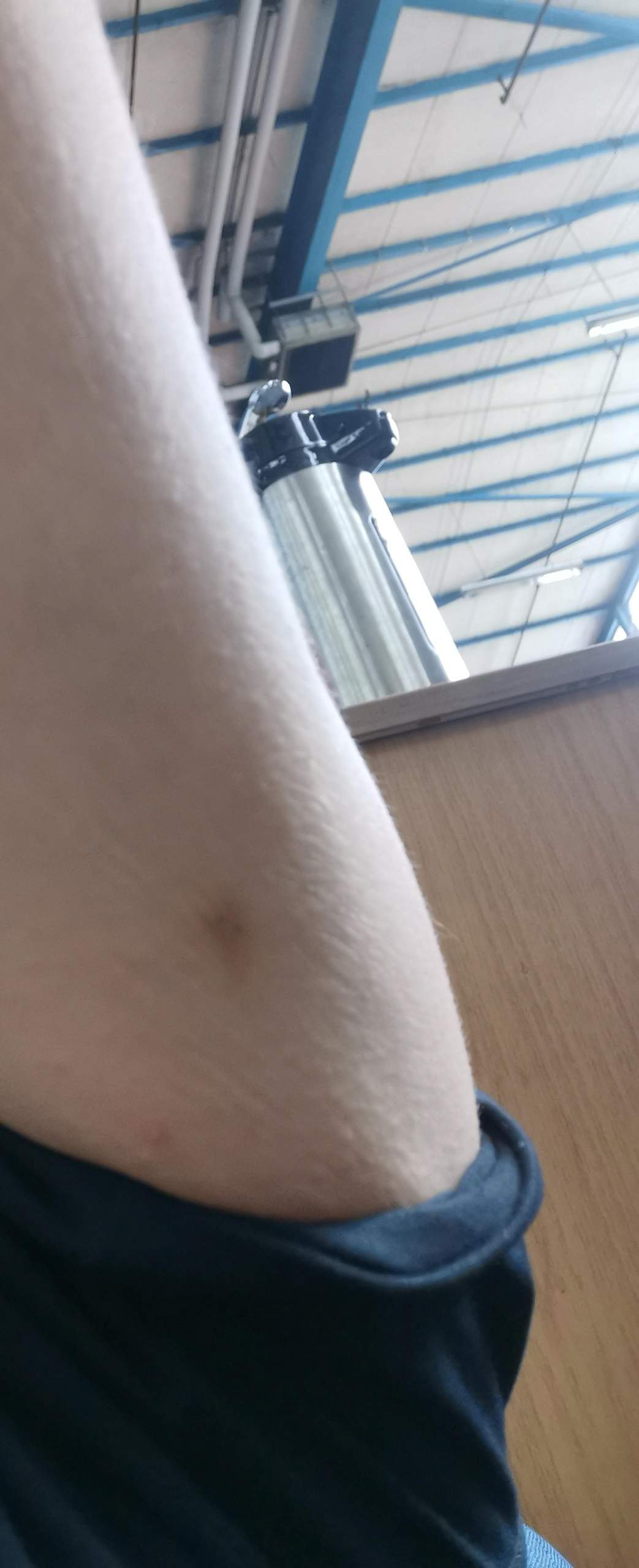 Wie Lange Bleibt Ein Bluterguss