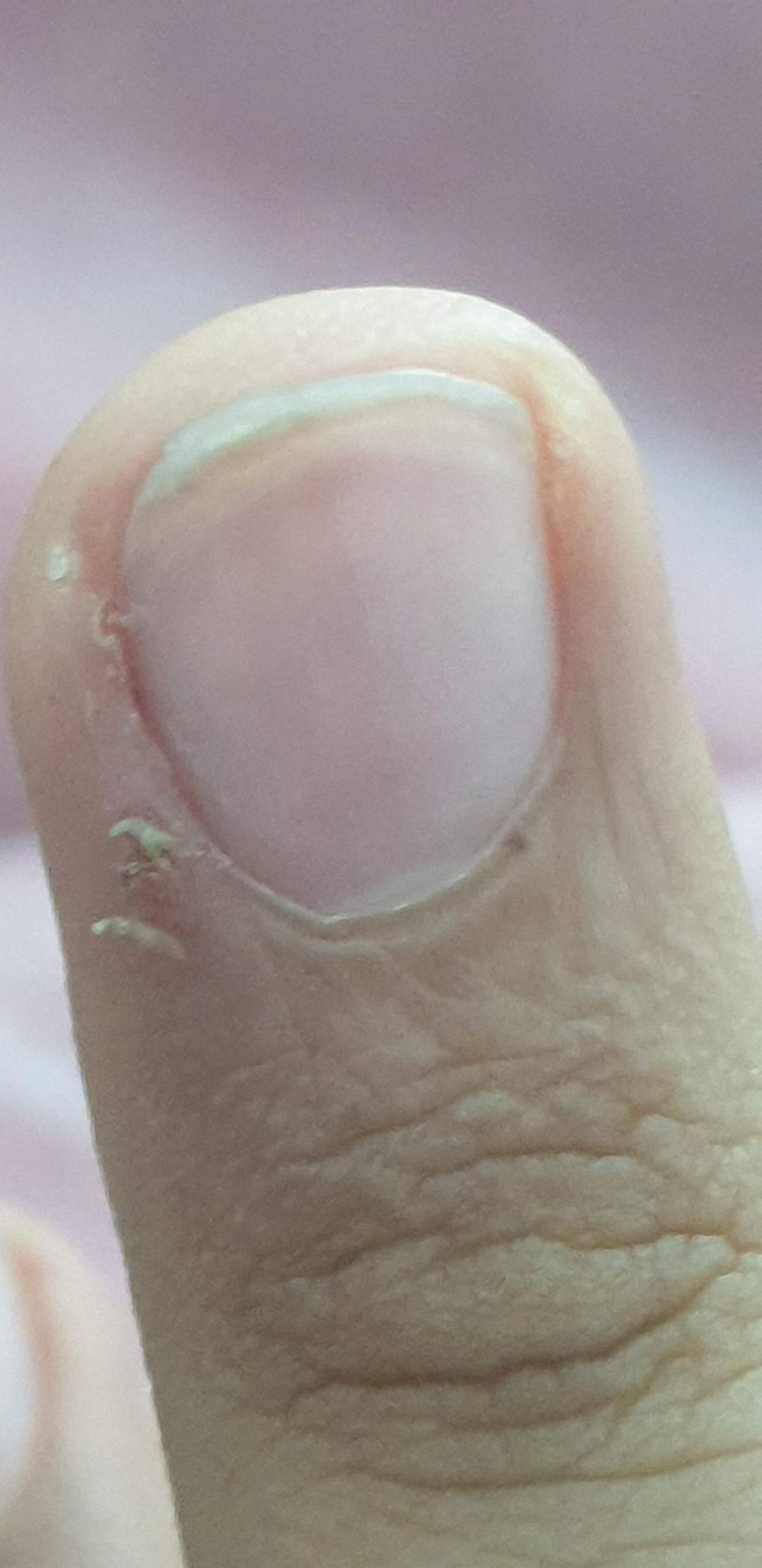 Blutige Finger und Risse was kann das sein? (Haut) Blutige Finger und Risse was kann das sein? (Haut)