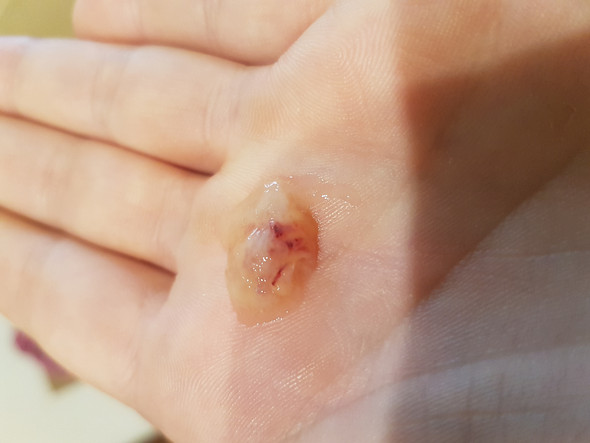 Blutiger Zaher Auswurf Beim Husten Gesundheit Und Medizin Erkaltung Lunge Blutiger Zaher Auswurf Beim Husten Gesundheit Und Medizin Erkaltung Lunge