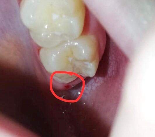 Blutiges Loch Im Zahnfleisch Gesundheit Und Medizin Zahne