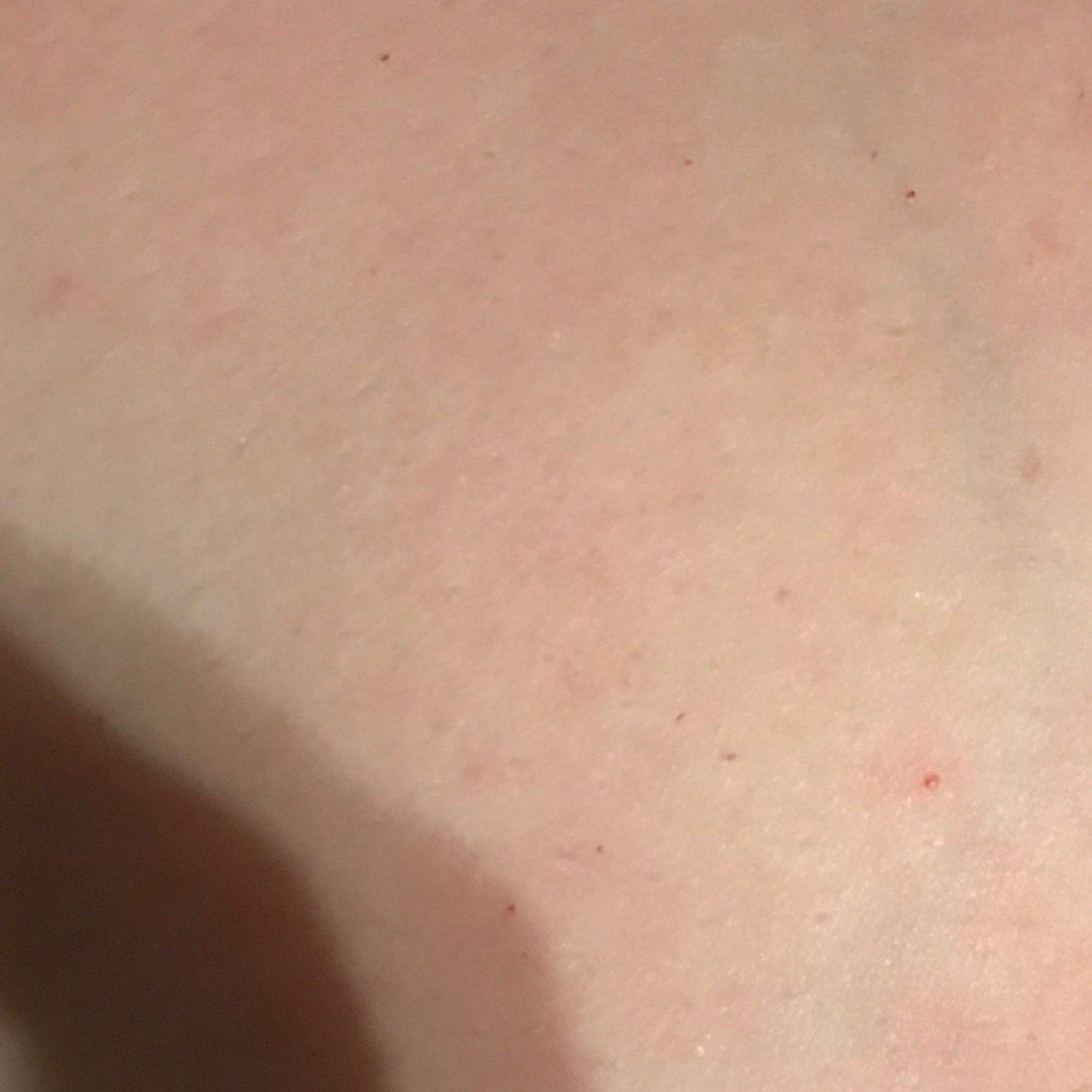 Blutpunkte auf der Haut bluten? (Gesundheit und Medizin, Blut)