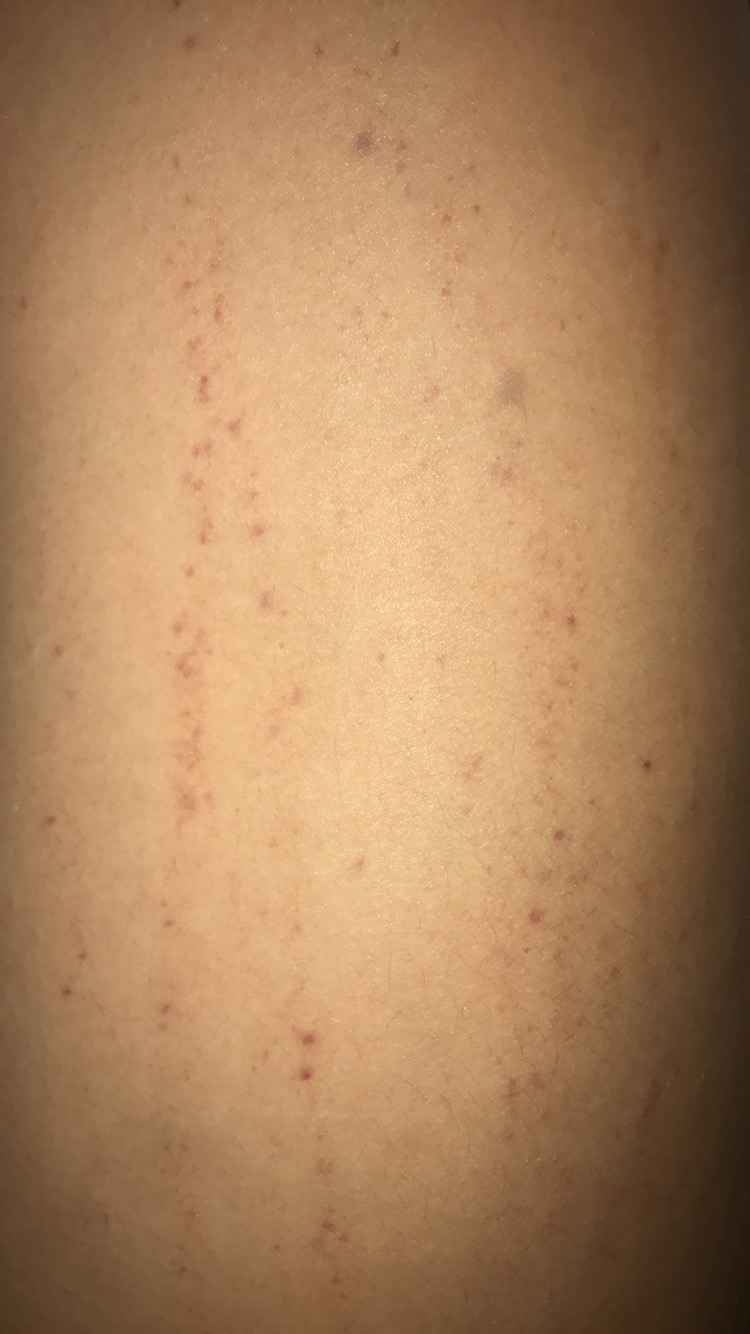 Blutungen unter der Haut was ist das ? (Gesundheit, Körper, Blut)