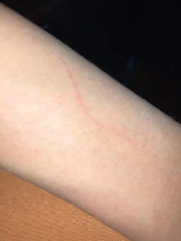 Blutvergiftung Gesundheit Und Medizin Blut Blutvergiftung Gesundheit Und Medizin Blut