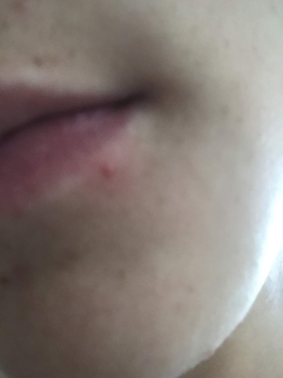 Blutvergiftung durch diesen Pickel? (Gesundheit)