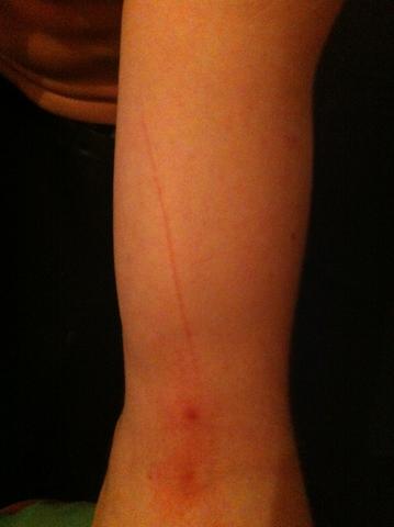 Blutvergiftung Gefaehrlich Gefahrlich Blutvergiftung Gefaehrlich Gefahrlich