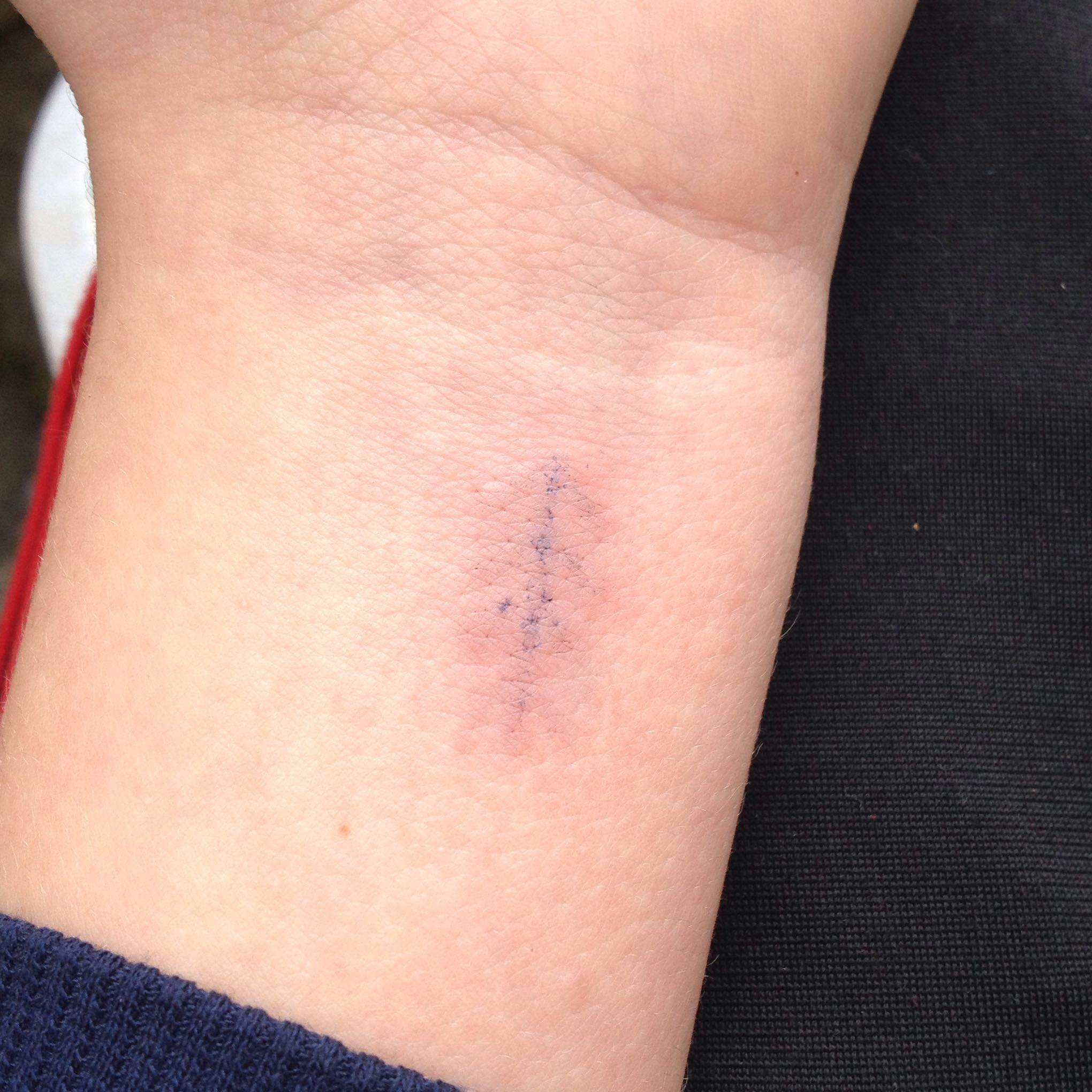 Woran Erkenne Ich Dass Mein Tattoo Abgeheilt Ist Blutvergiftung?! Hilfe! Tatoo?! (Tattoo, Vergiftung)