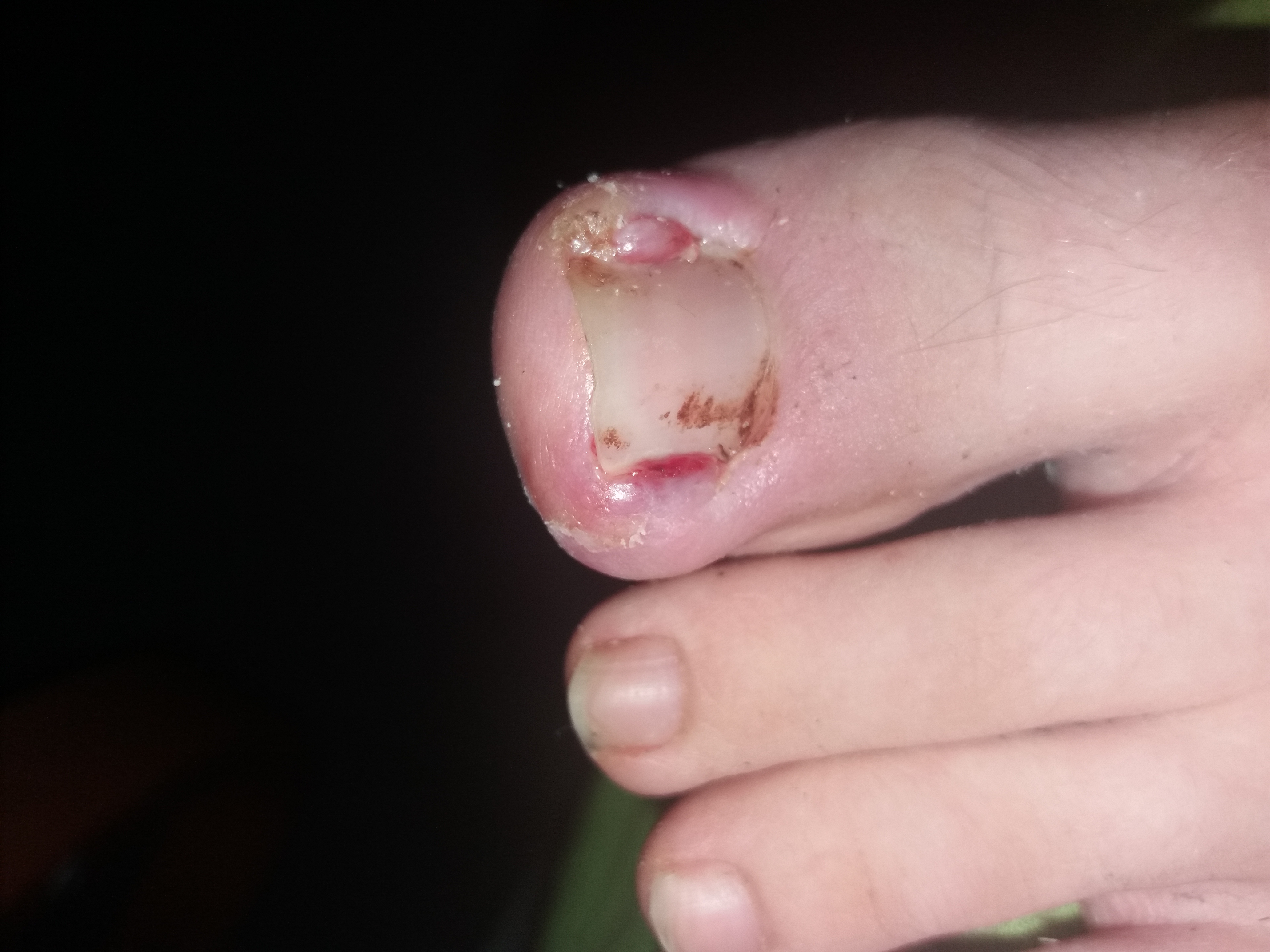 Blutvergiftung zeh Blutvergiftung zeh