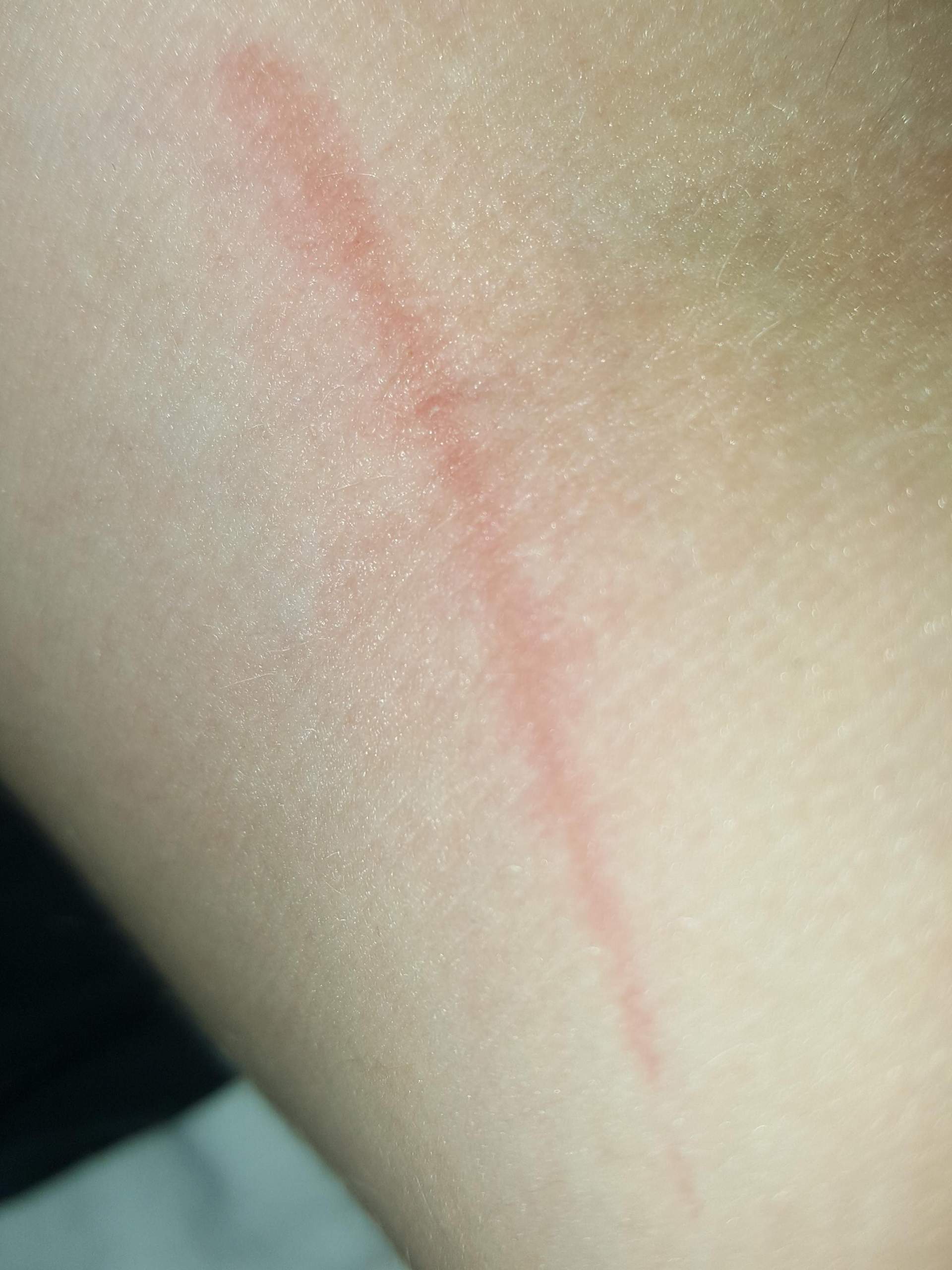 Aussehen einer Blutvergiftung: Wie sehen die typischen Streifen aus? Aussehen einer Blutvergiftung: Wie sehen die typischen Streifen aus?