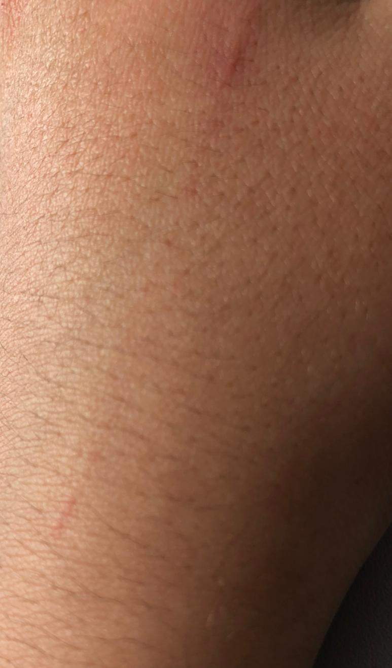 Blutvergiftung trotz keiner offenen vereiterten Wunde? (Gesundheit und