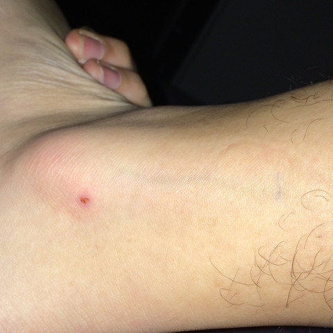 Blutvergiftung Wegen Dem Kleinen Ding Arzt Angst Blutvergiftung Wegen Dem Kleinen Ding Arzt Angst