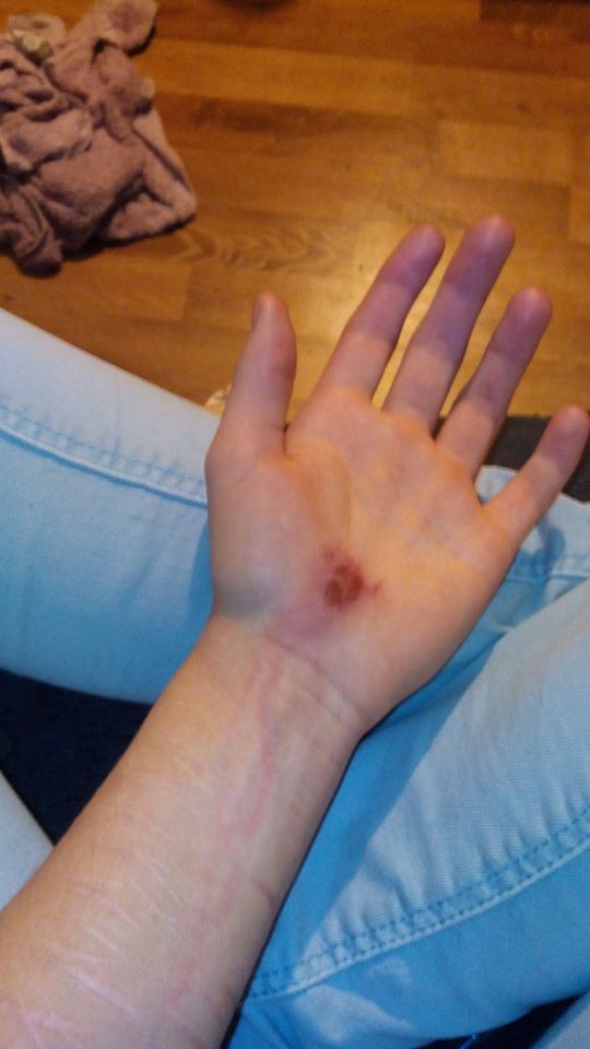 Blutvergiftung/lymphangitis? (Gesundheit, Krankenhaus, Verletzung)