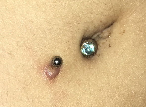 bnp zu kurz und deshalb entzundet piercing bauchnabelpiercing