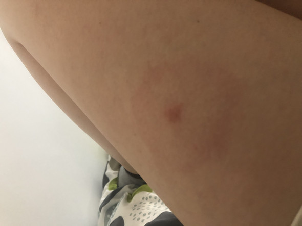 Borreliose Durch Gelsenstich Gesundheit Und Medizin Arzt Medizin Und Gesundheit Borreliose Durch Gelsenstich Gesundheit Und Medizin Arzt Medizin Und Gesundheit