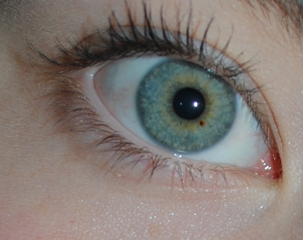 braauner Fleck im Auge? (Gesundheit, Augen)