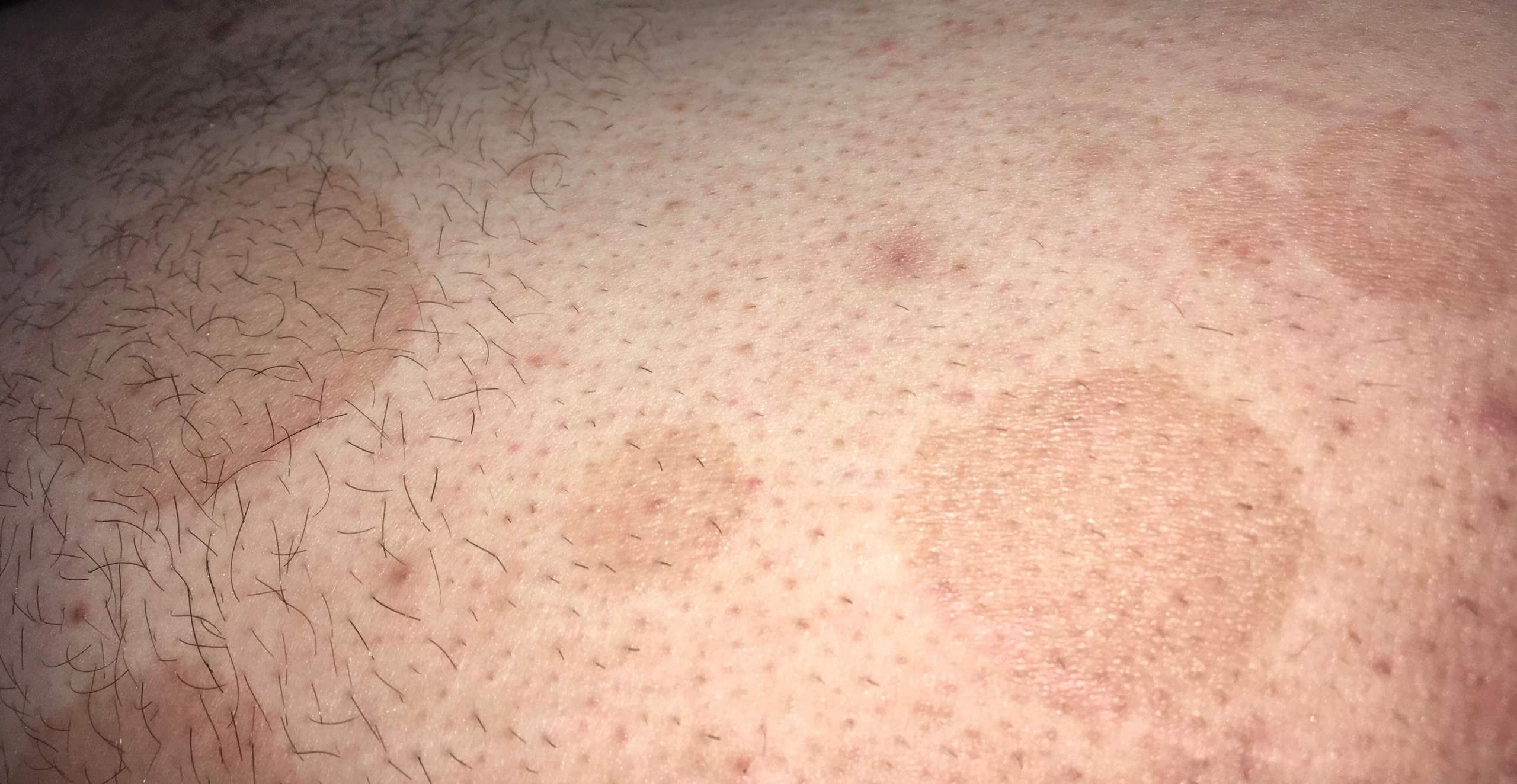 Bräunliche Flecken Oberschenkel? (Gesundheit und Medizin, Hautprobleme)