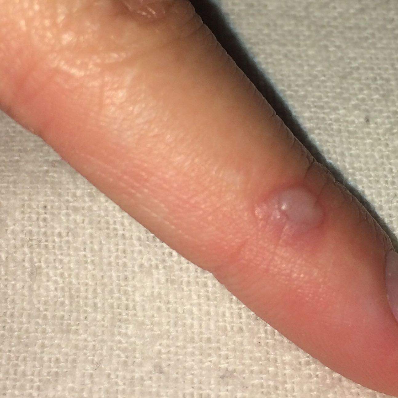 Brandblase Am Finger Was Tun Brandblase Am Finger Was Tun