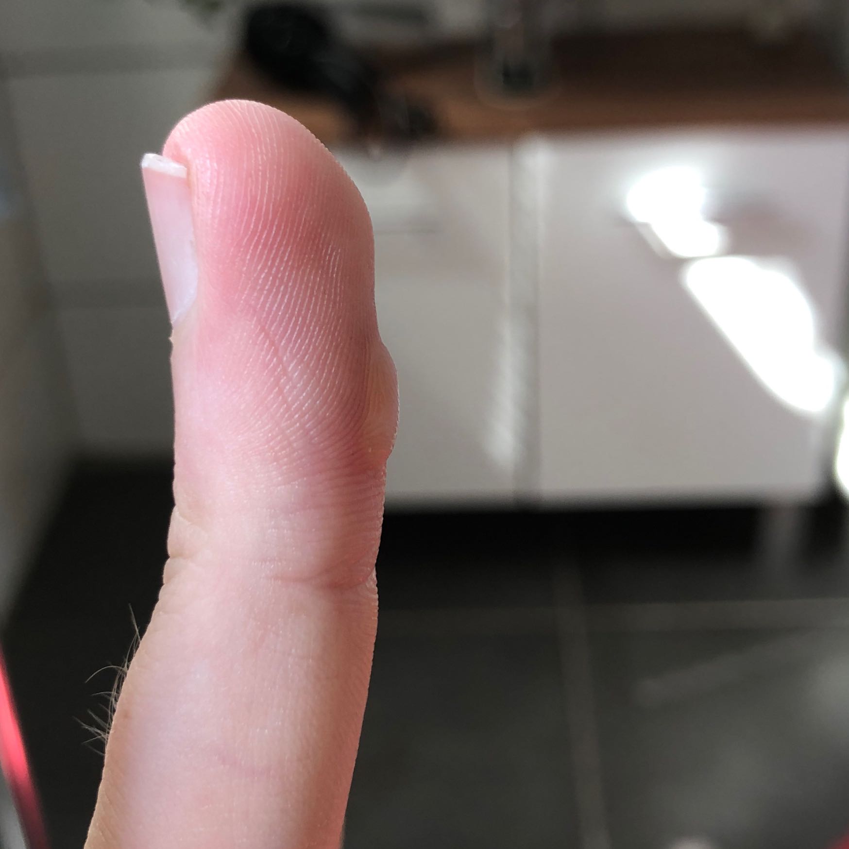 Brandblase an Finger, was tun? (Schmerzen, Verletzung, Hand)