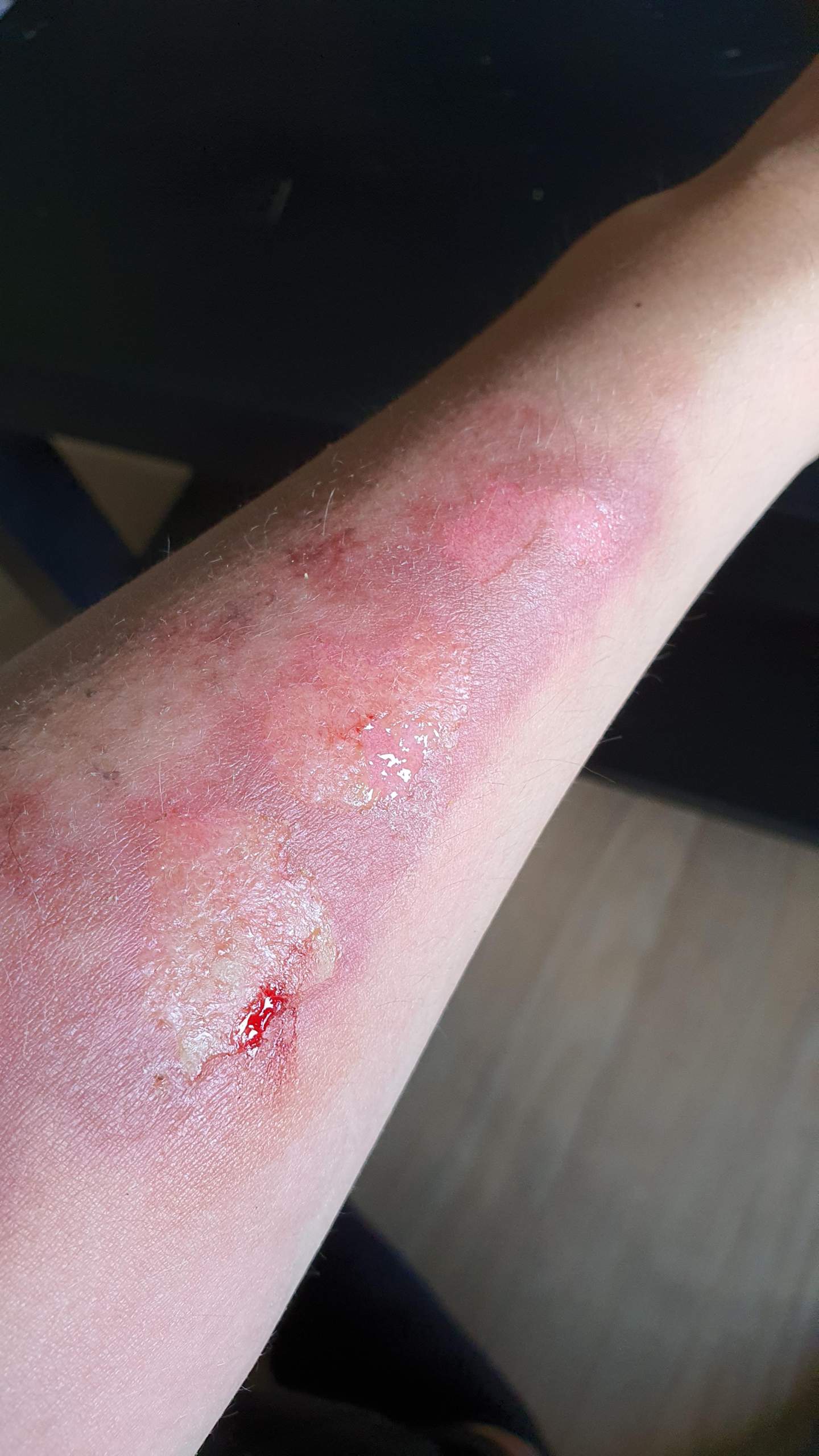 Brandwunde? Infektion? (Gesundheit und Medizin, Verletzung, Wunde)