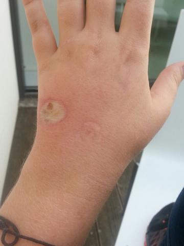 brandwunde seit 2 tagen (Arzt)