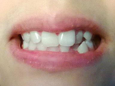 meine Zähne - (Zähne, Zahnspange)