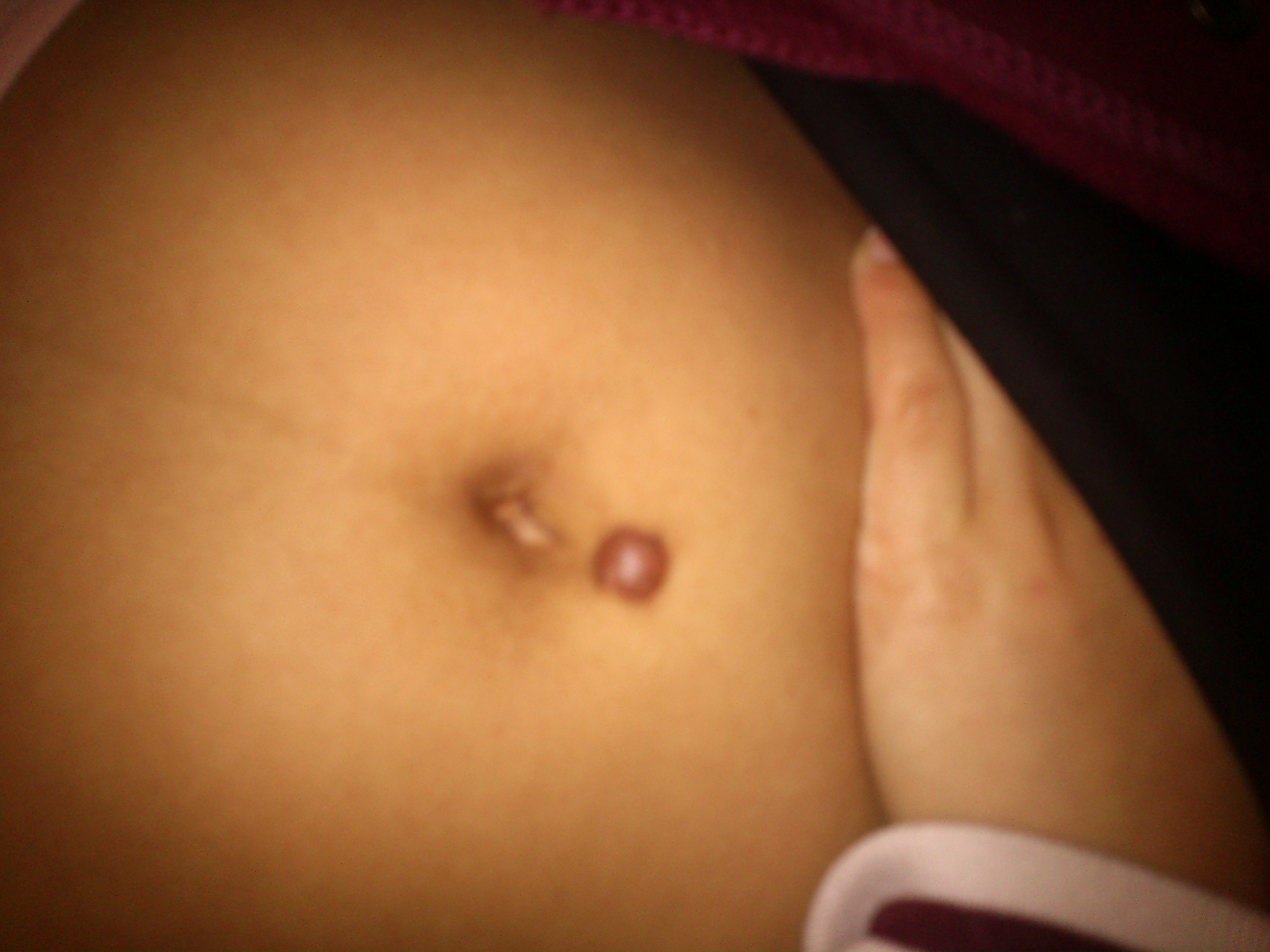Was Tun Gegen Wildfleisch Am Bauchnabelpiercing