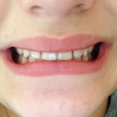 Meine Zähne ...................... - (Zahnspange, Kieferorthopäde, unterkiefer)