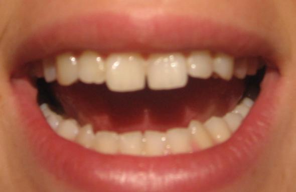 Meine oberen Zähne... - (Gesundheit, Zähne, Zahnarzt)